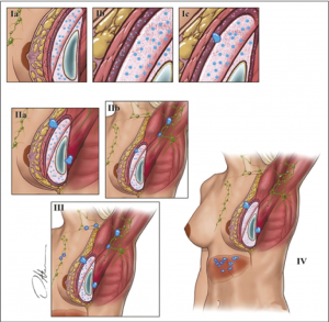 grades de contracture capsulaire