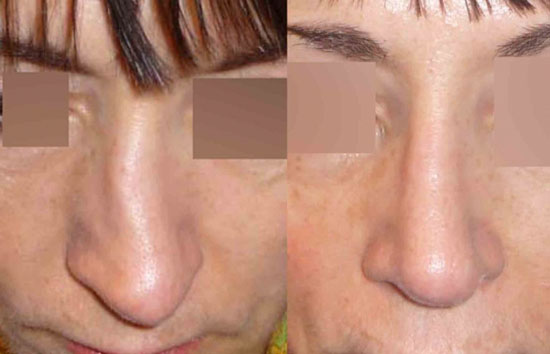 différence septoplastie rhinoplastie