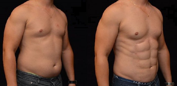 Abdominal etching Maroc