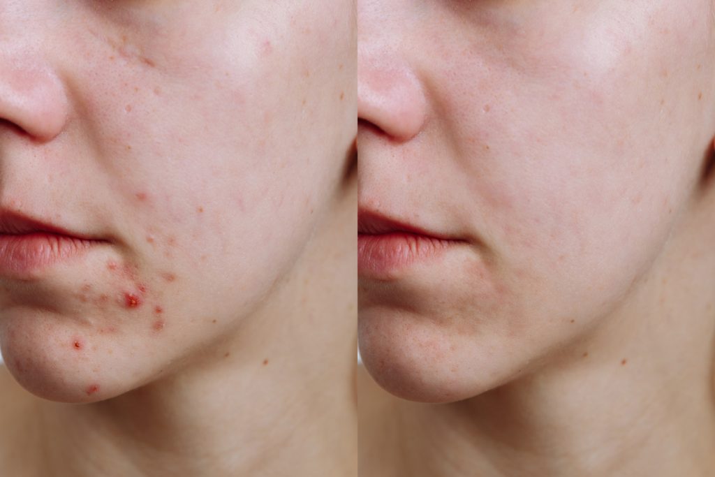 traitement non chirurgical de l'acné