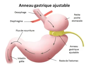 anneau gastrique