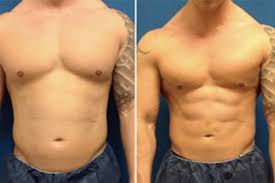 Chirurgie esthétique masculine au Maroc