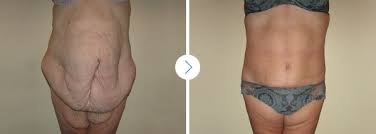chirurgie reconstructrice post-bariatrique
