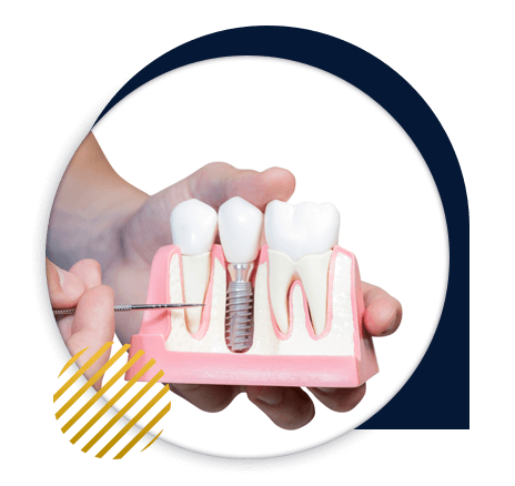 Dental implants Morocco