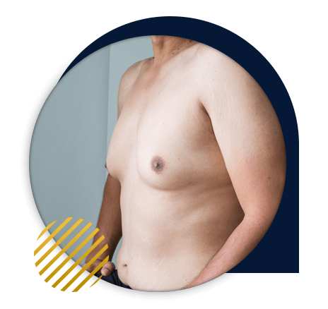 gynecomastie au Maroc